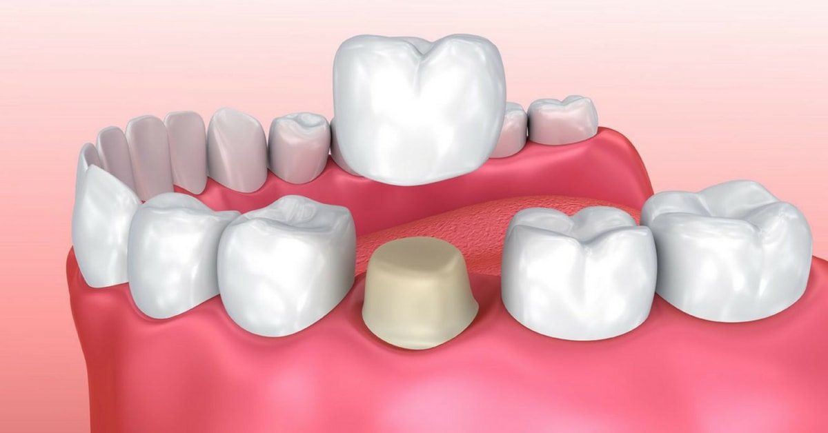 dental_crown_indications_sm.jpg